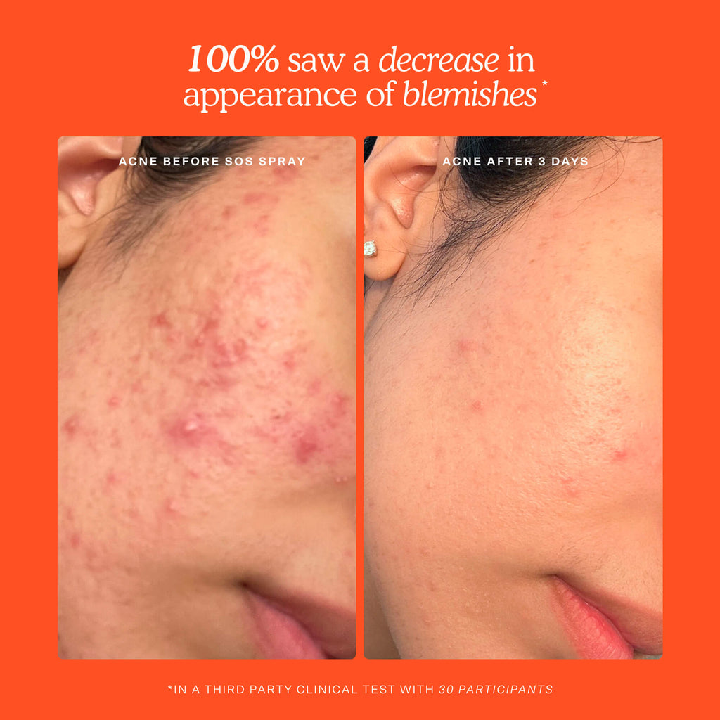 SOS 3-Step Skincare Set